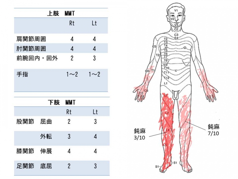 首が悪くなったら,手首や足に感覚がなくなる.力も弱くなる.さぁーどう考える