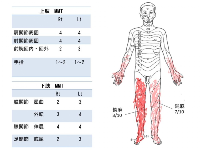 首が悪くなったら，手首や足に感覚がなくなる．力も弱くなる．さぁーどう考える